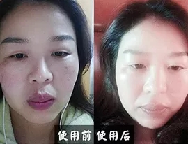 點(diǎn)痣后的修復(fù)對比